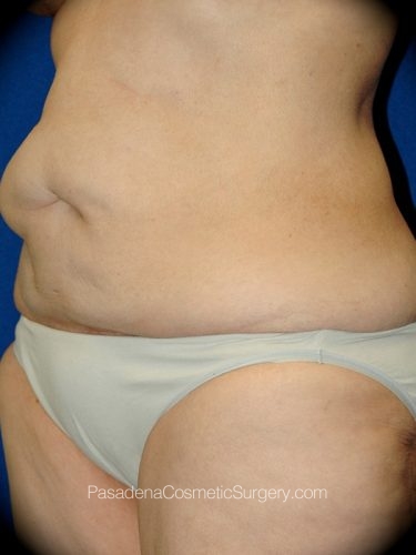 Body Lift Patient 05 Before - 2