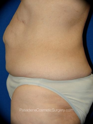 Body Lift Patient 05 Before - 3