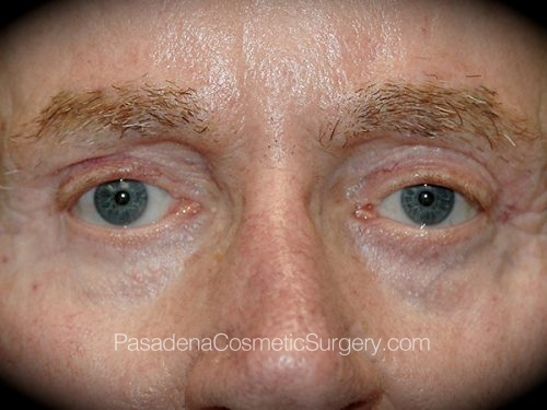 Eyelid Surgery Patient 25 After