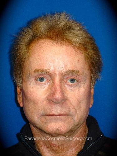 Facelift Patient 17 After