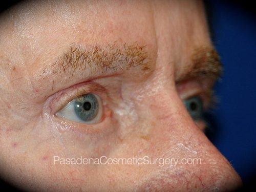Eyelid Surgery Patient 25 After - 2