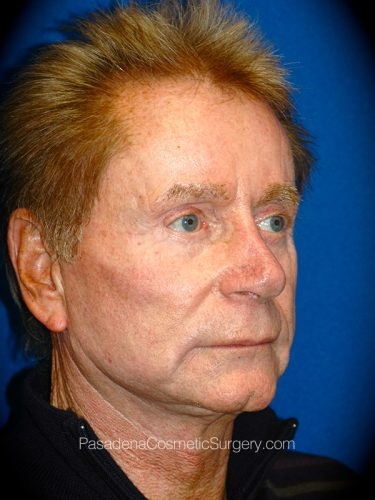 Facelift Patient 17 After - 2