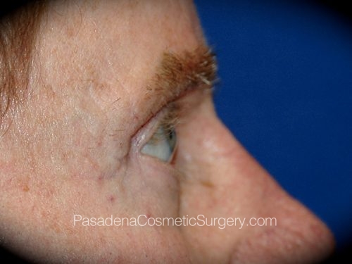 Eyelid Surgery Patient 25 After - 3