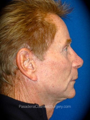 Facelift Patient 17 After - 3