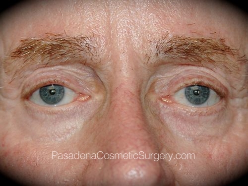 Eyelid Surgery Patient 25 Before