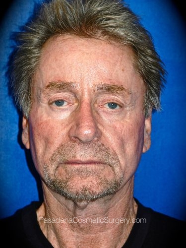 Facelift Patient 17 Before