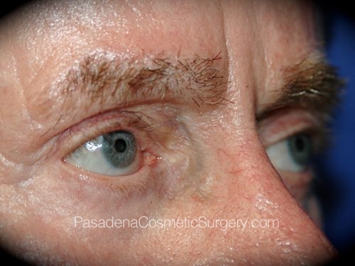 Eyelid Surgery Patient 25 Before - 2