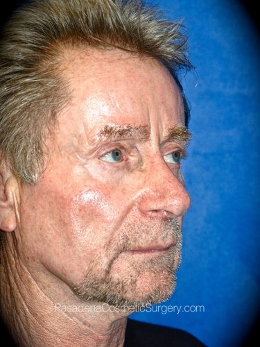 Facelift Patient 17 Before - 2