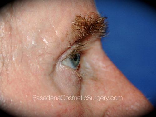 Eyelid Surgery Patient 25 Before - 3