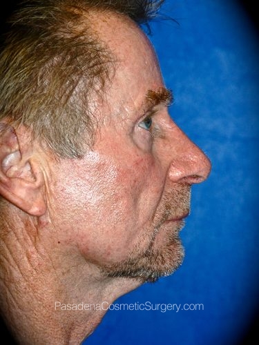 Facelift Patient 17 Before - 3