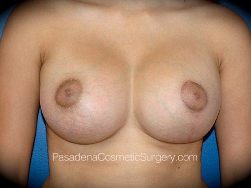 Breast Augmentation with Mastopexy Patient 10 After