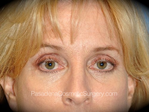 Eyelid Surgery Patient 26 After