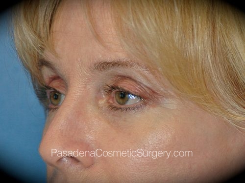 Eyelid Surgery Patient 26 After - 2