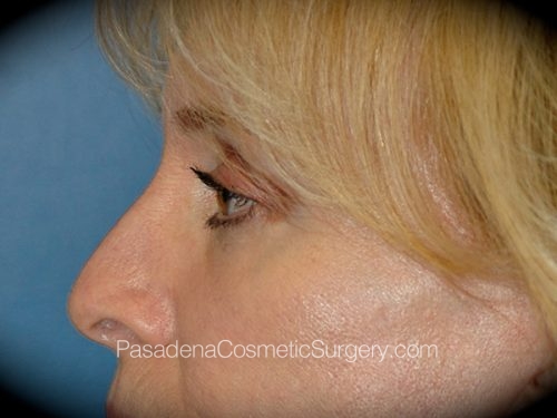 Eyelid Surgery Patient 26 After - 3