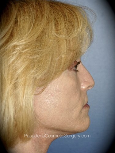 Laser Skin Resurfacing Patient 03 After - 2