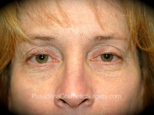 Eyelid Surgery Patient 26 Before