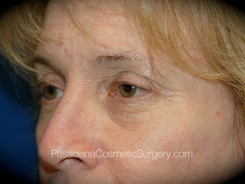 Eyelid Surgery Patient 26 Before - 2
