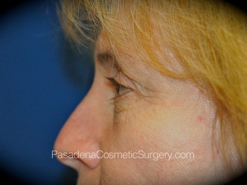 Eyelid Surgery Patient 26 Before - 3