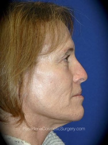 Laser Skin Resurfacing Patient 03 Before - 2