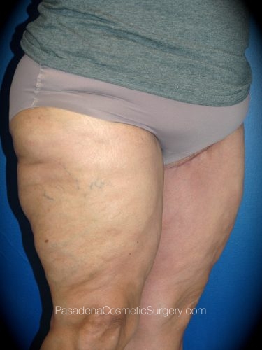Thighplasty Patient 02 After - 2
