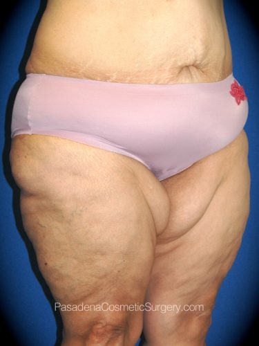 Thighplasty Patient 02 Before - 2