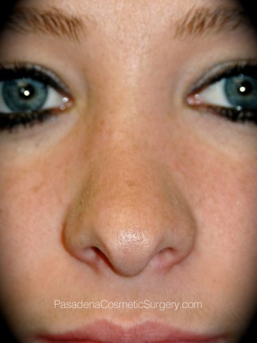 Rhinoplasty Patient 12 After