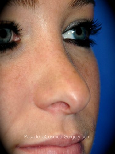 Rhinoplasty Patient 12 After - 2