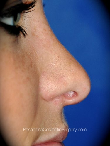 Rhinoplasty Patient 12 After - 3