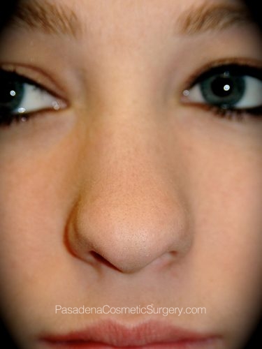Rhinoplasty Patient 12 Before