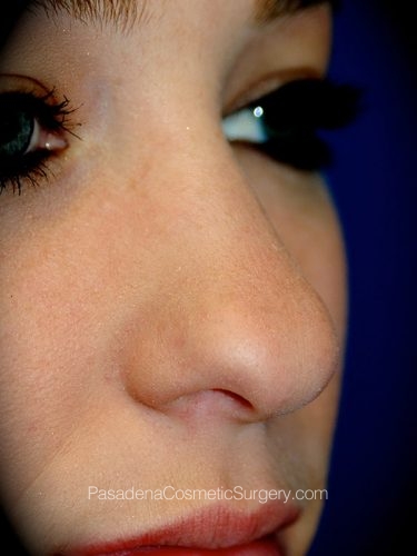 Rhinoplasty Patient 12 Before - 2