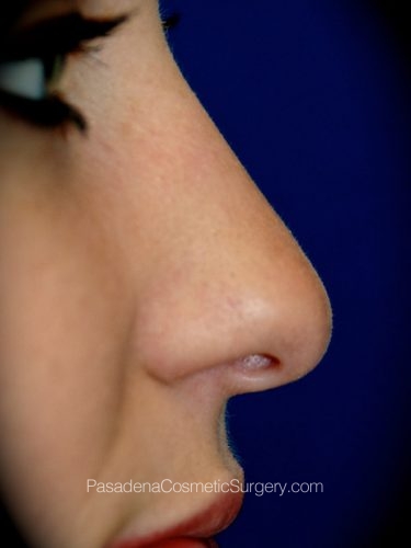 Rhinoplasty Patient 12 Before - 3