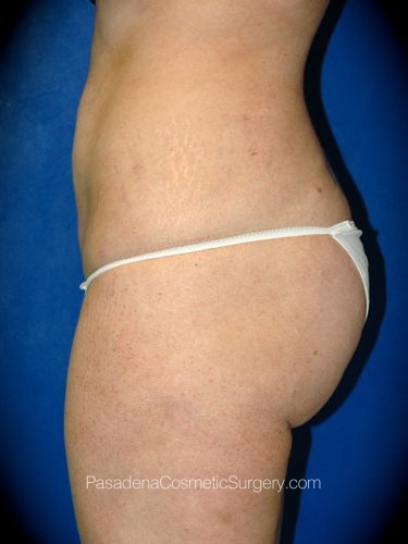 Liposuction Patient 04 After - 2
