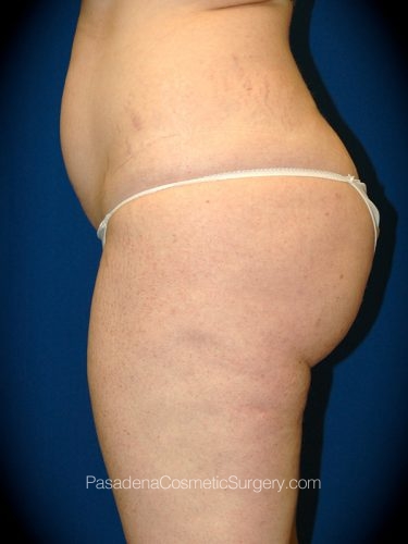 Liposuction Patient 04 Before - 2