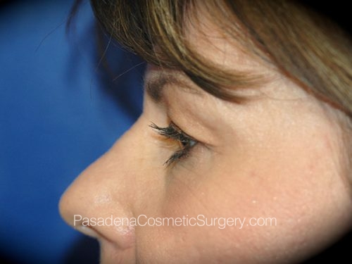 Brow Lift Patient 06 Before - 2