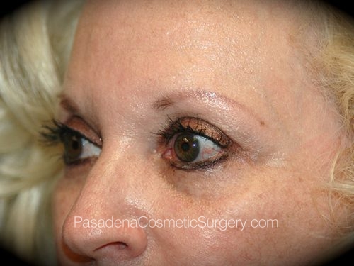 Brow Lift Patient 07 After - 2