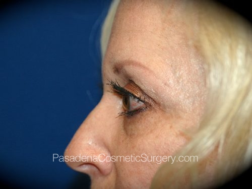 Brow Lift Patient 07 After - 3