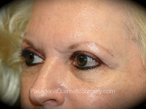 Brow Lift Patient 07 Before - 2