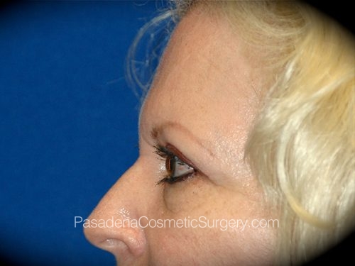 Brow Lift Patient 07 Before - 3