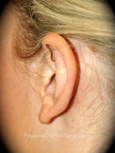 Ear Surgery Patient 02 After - 2