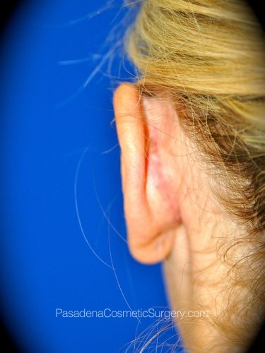 Ear Surgery Patient 02 After - 3