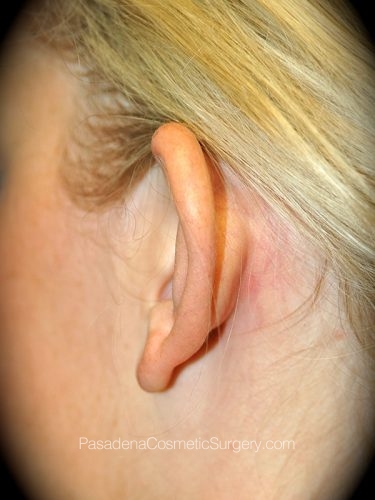 Ear Surgery Patient 02 Before - 2
