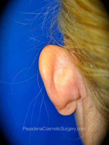 Ear Surgery Patient 02 Before - 3