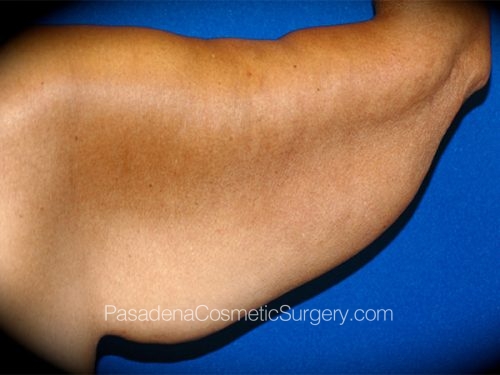 Arm Lift Patient 12 Before - 2