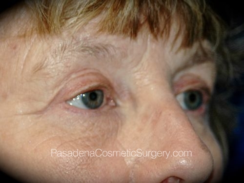 Eyelid Surgery Patient 27 After - 2
