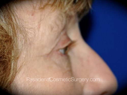 Eyelid Surgery Patient 27 After - 3