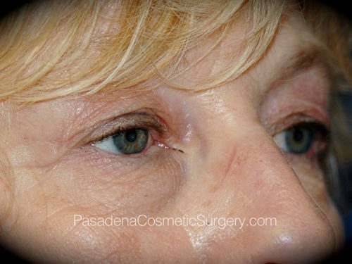 Eyelid Surgery Patient 27 Before - 2