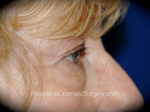 Eyelid Surgery Patient 27 Before - 3