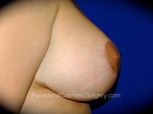 Breast Augmentation with Mastopexy Patient 11 After - 3