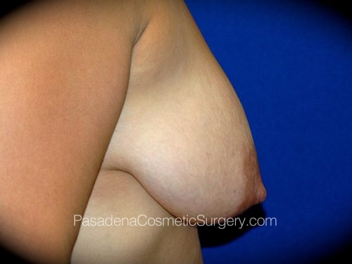 Breast Augmentation with Mastopexy Patient 11 Before - 3