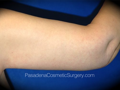 Arm Lift Patient 13 After - 2